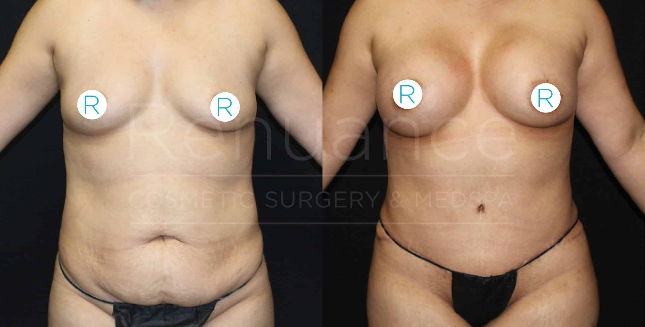 A before and after image showing the results of cosmetic surgery on a person's torso. The left side of the image shows the person's body before surgery, while the right side shows the body post-surgery with noticeable changes in contour and appearance. The person is standing upright with their arms slightly out to their sides in both images, and their chest is covered with circular markers labeled "R". The background is plain and dark.