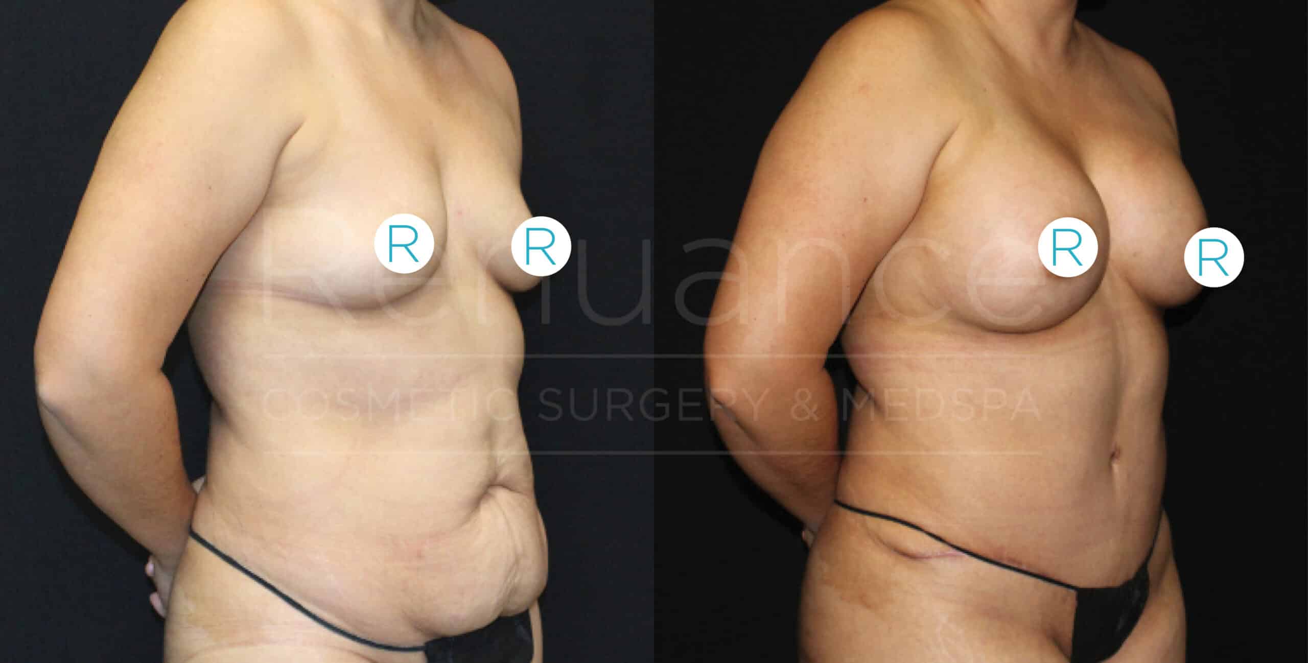 Comparison of a woman before and after a cosmetic surgery. The left side shows the woman pre-surgery with more abdominal sagging, while the right side shows the same woman post-surgery with a flatter abdominal area. She is wearing the same minimal black undergarment and has identification stickers on her chest in both images.