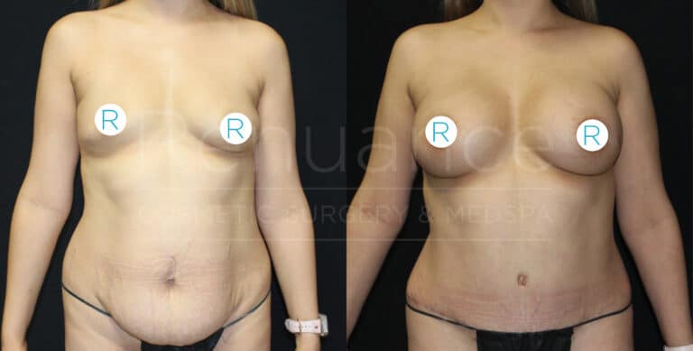 Before and after images of a woman showing the results of cosmetic surgery. The left image shows her before surgery, with sagging skin around the abdomen and breasts. The right image shows her after surgery, with a flatter and tightened abdomen and enhanced breasts. She is wearing black underwear in both images. White circular markers with the letter "R" are placed on her breasts for reference.