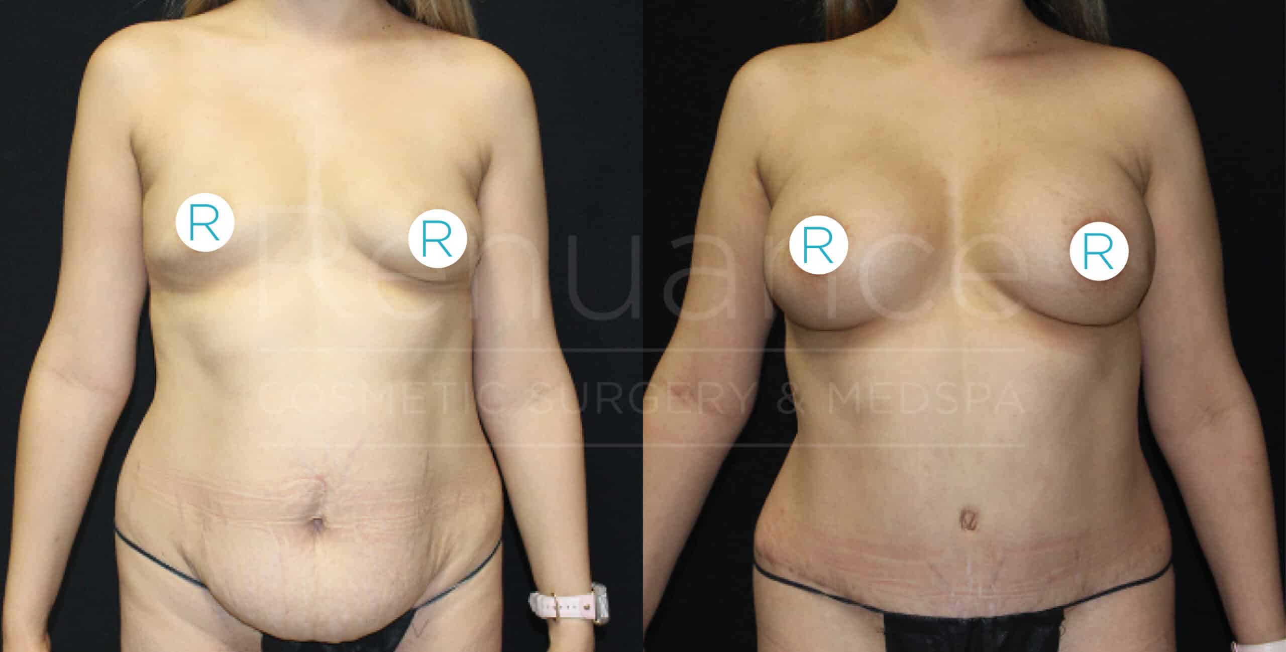 Before and after images of a woman showing the results of cosmetic surgery. The left image shows her before surgery, with sagging skin around the abdomen and breasts. The right image shows her after surgery, with a flatter and tightened abdomen and enhanced breasts. She is wearing black underwear in both images. White circular markers with the letter "R" are placed on her breasts for reference.
