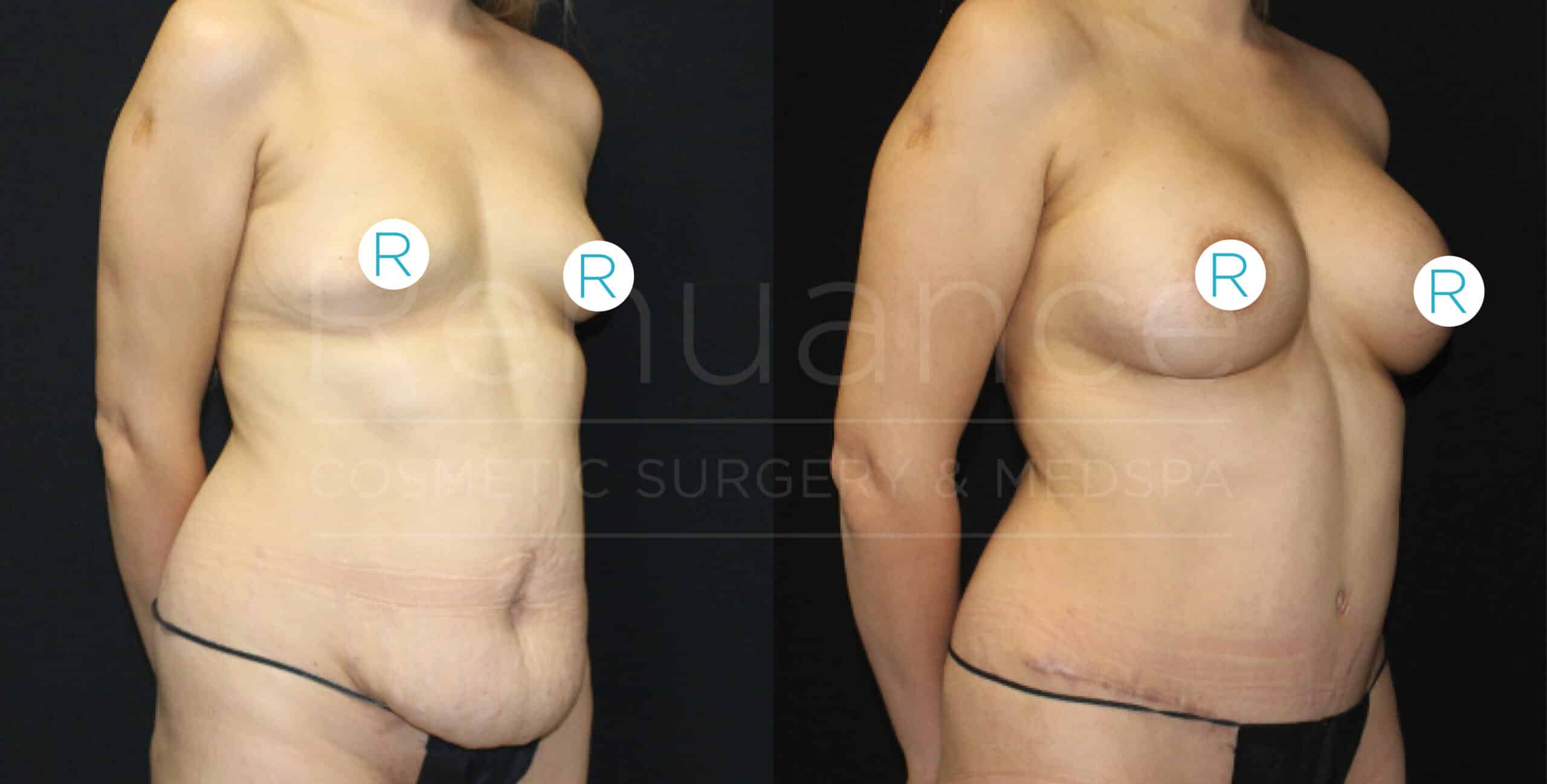 A side-by-side comparison image showing the before and after results of a cosmetic surgery procedure. On the left, a woman is seen with sagging skin around the midsection, breasts, and upper arms. On the right, the same woman is shown after surgery, with a firmer midsection, lifted and fuller breasts, and smoother upper arms. Both images are marked with an "R" to indicate the right side of the body. The background is solid black.
