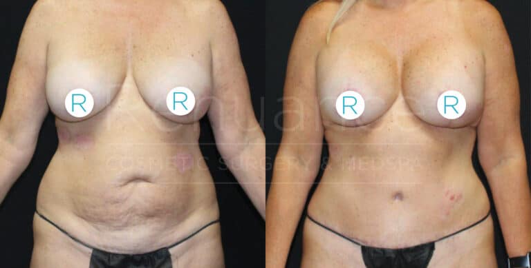 "Side-by-side comparison of a woman's torso showing before and after results of cosmetic surgery. The left image displays the body before surgery, with visible signs of sagging skin and lack of contour. The right image shows the body after surgery, with a more defined and toned appearance. Both images have 'R' stickers covering the breast area for modesty."
