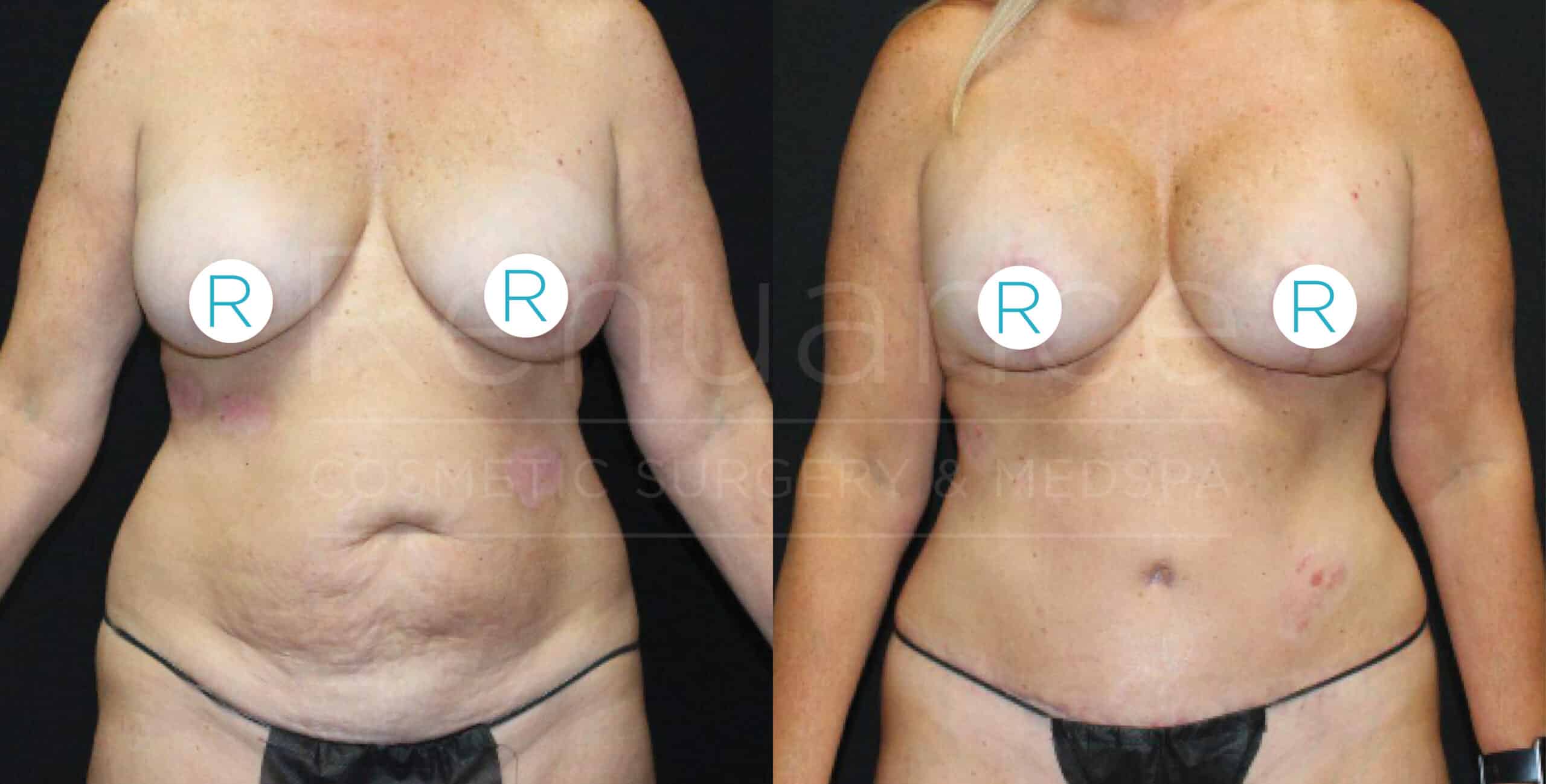 "Side-by-side comparison of a woman's torso showing before and after results of cosmetic surgery. The left image displays the body before surgery, with visible signs of sagging skin and lack of contour. The right image shows the body after surgery, with a more defined and toned appearance. Both images have 'R' stickers covering the breast area for modesty."