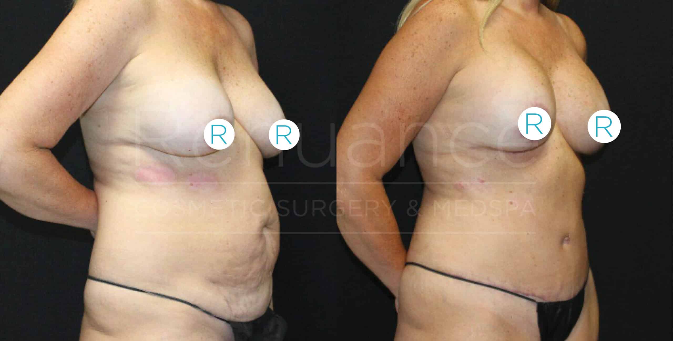 An image showing two side-by-side comparisons of a woman's torso before and after cosmetic surgery. In the left image, her body shows a saggy abdomen and breasts. In the right image, her body appears more toned, with lifted and fuller breasts. The images are watermarked with "Nuance Cosmetic Surgery & MedSpa," and both chest areas are marked with an "R" symbol.