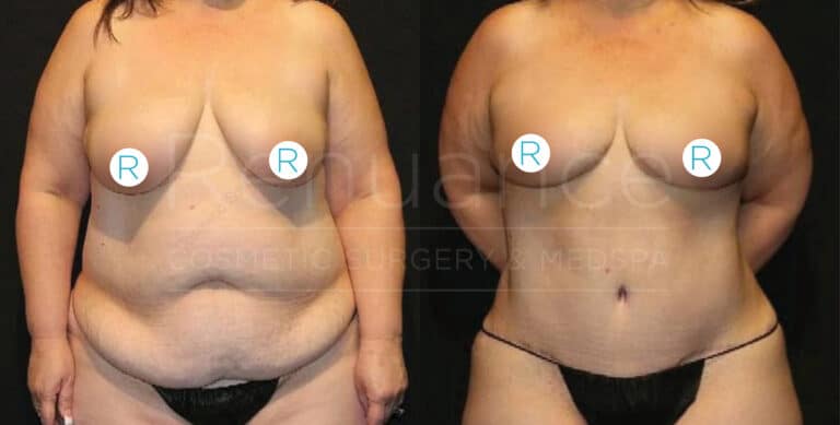 Before and after image of a woman showcasing the results of a cosmetic surgical procedure. The left side shows the woman before the surgery with more prominent body fat, while the right side shows the woman after the surgery with a slimmer and more toned appearance.