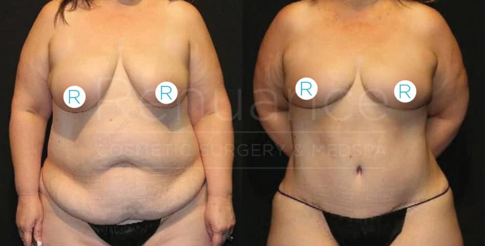 Before and after image of a woman showcasing the results of a cosmetic surgical procedure. The left side shows the woman before the surgery with more prominent body fat, while the right side shows the woman after the surgery with a slimmer and more toned appearance.