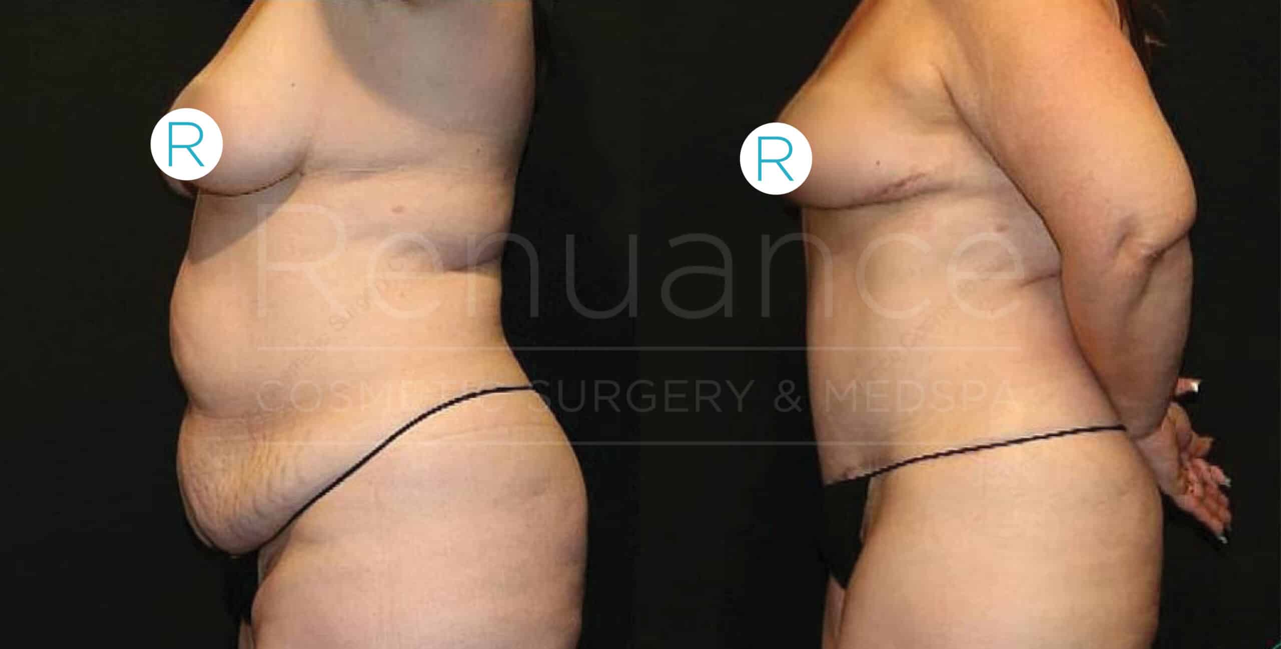 Before and after side-by-side comparison photos of an individual who appears to have undergone body contouring surgery. The left image shows the person before the procedure, with a larger abdomen and sagging skin. The right image shows the person after the procedure, with a visibly slimmer and more toned abdomen area. Both images are taken against a black background.