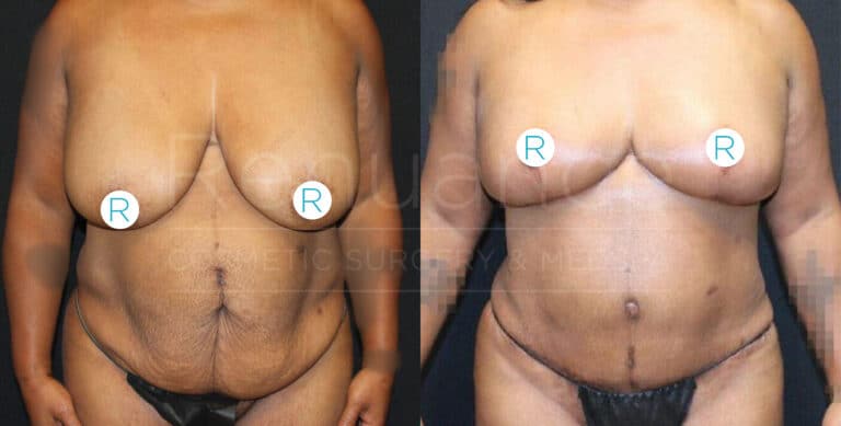 A pair of before-and-after photos shows a woman's torso from the front. In the left image, the "before" picture, her breasts are significantly sagging. In the right image, the "after" picture, her breasts appear lifted and more contoured, with noticeable changes in shape and size. She is wearing black underwear in both images, and stickers labeled "R" are placed on each breast in both photos.
