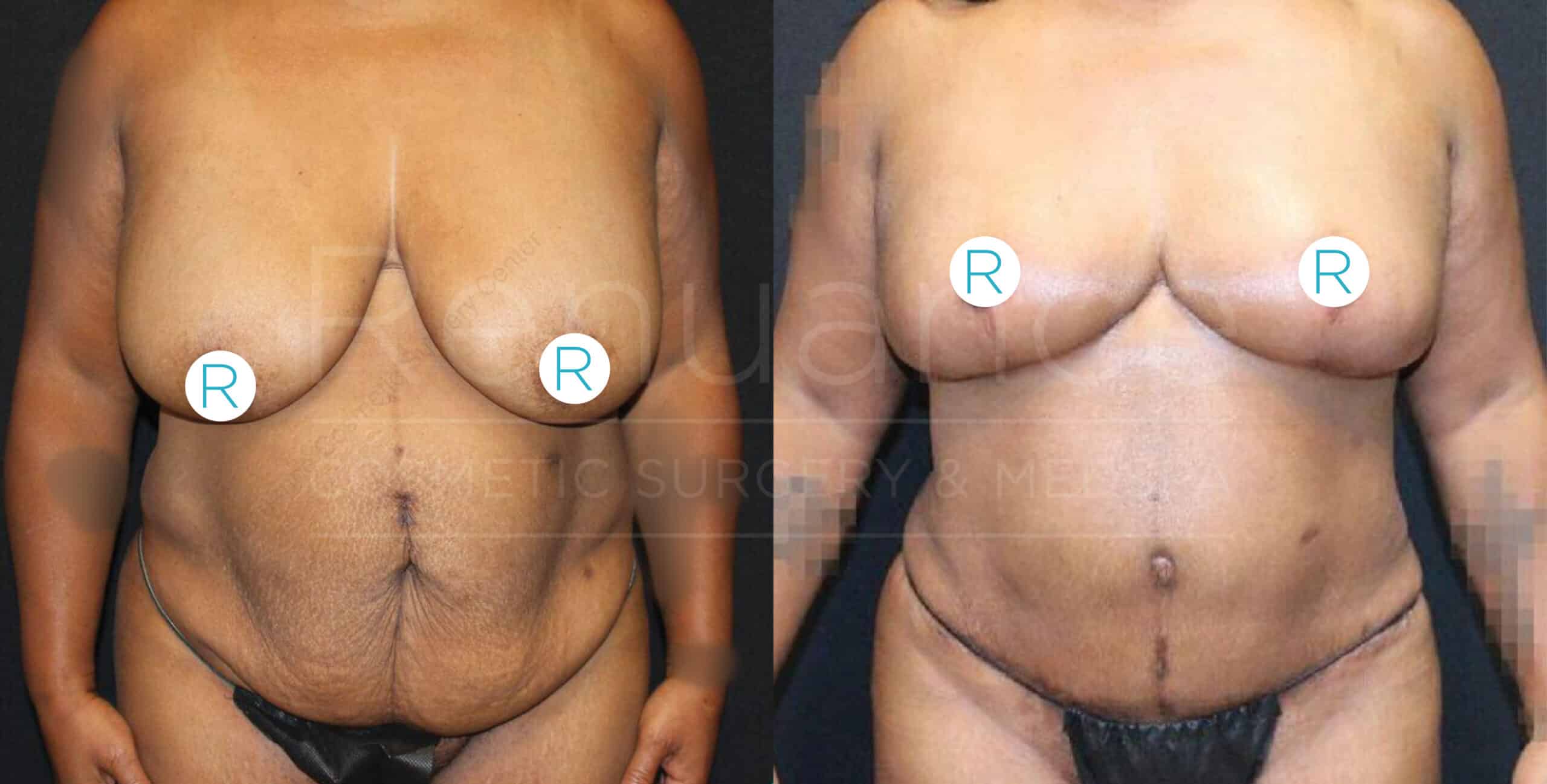 A pair of before-and-after photos shows a woman's torso from the front. In the left image, the "before" picture, her breasts are significantly sagging. In the right image, the "after" picture, her breasts appear lifted and more contoured, with noticeable changes in shape and size. She is wearing black underwear in both images, and stickers labeled "R" are placed on each breast in both photos.
