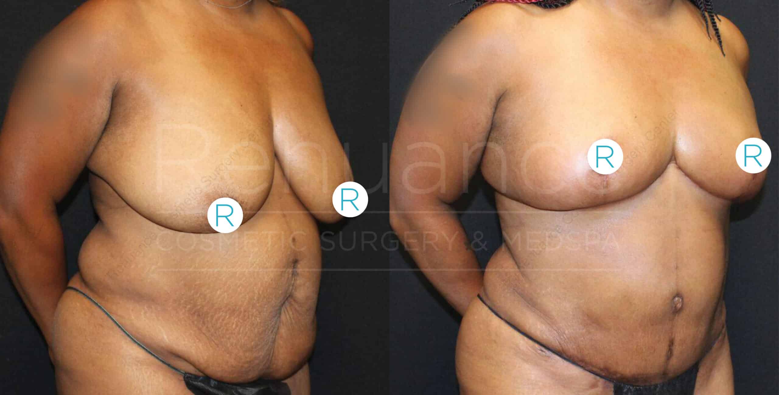 "Before and after image of a person who appears to have undergone a body contouring surgery. The left side shows the person before the procedure, and the right side shows the person after the procedure with a noticeable reduction in body fat and improved body shape."