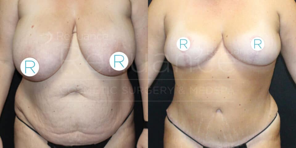 A side-by-side comparison image showing the front view of a person's torso before and after cosmetic surgery. The image on the left shows the torso before surgery, with visible sagging and excess skin, particularly around the abdomen. The image on the right shows significant improvement after surgery, with a more toned and firm appearance in both the abdomen and breast areas. The letters "R" are marked on the chest in both images. The background is black in both images.