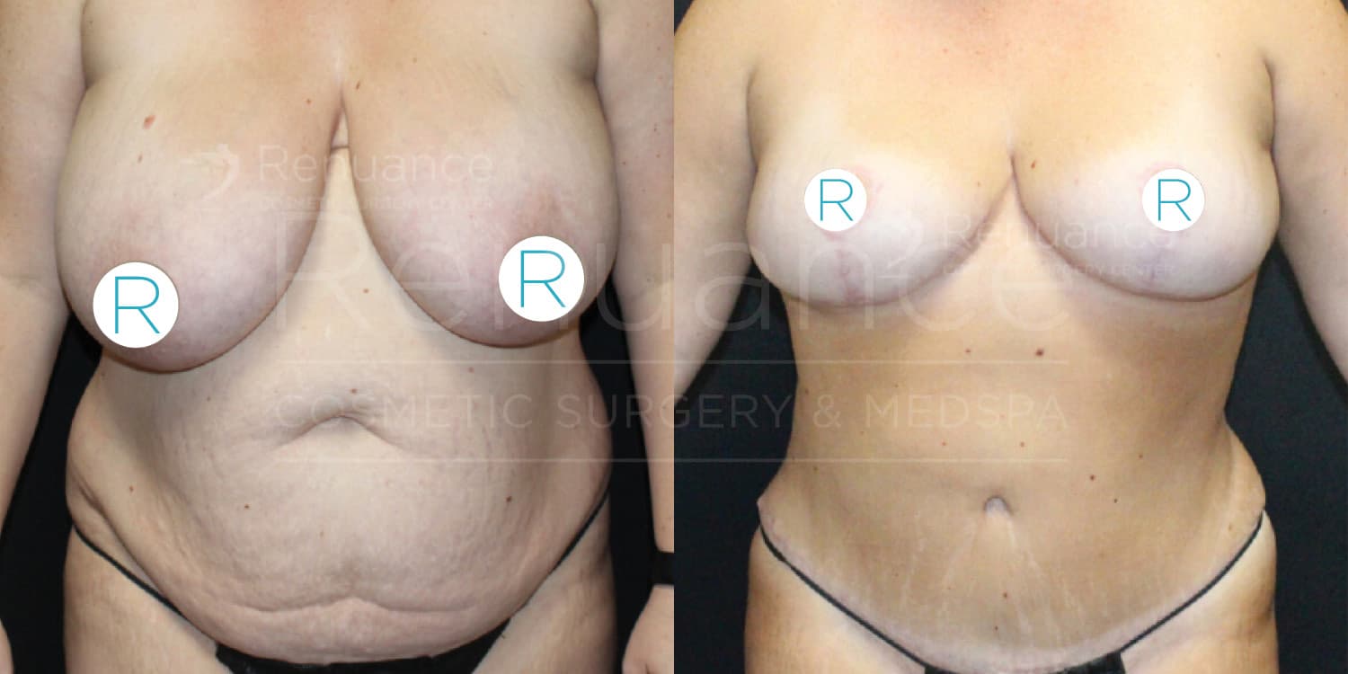 A side-by-side comparison image showing the front view of a person's torso before and after cosmetic surgery. The image on the left shows the torso before surgery, with visible sagging and excess skin, particularly around the abdomen. The image on the right shows significant improvement after surgery, with a more toned and firm appearance in both the abdomen and breast areas. The letters "R" are marked on the chest in both images. The background is black in both images.