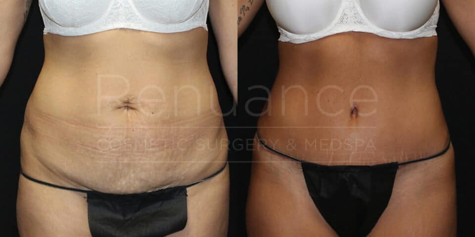 a before and after of a tummy tuck, front view