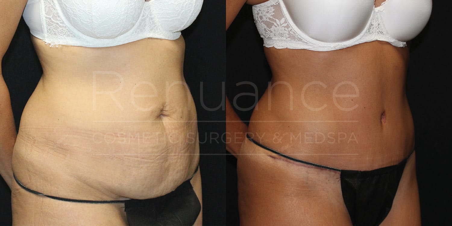 a female patient from murrieta before and after a tummy tuck