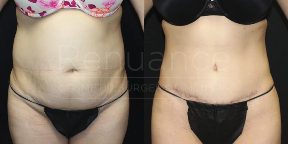 Before and after tummy tuck results showing refined belly area