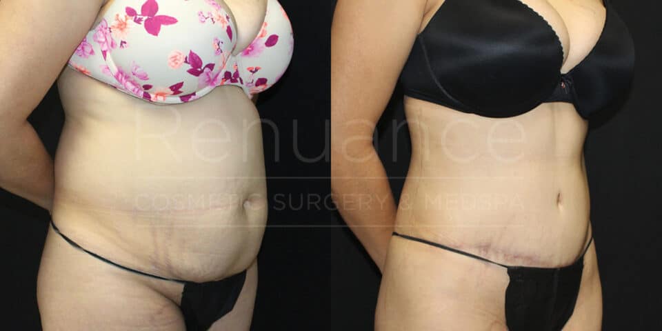 Comprehensive tummy tuck before and after from our Temecula clinic