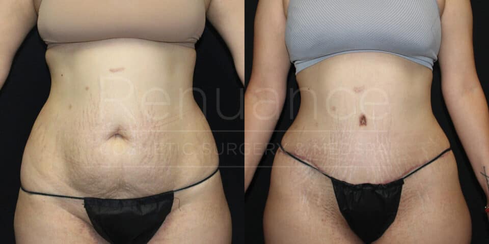 Before and after tummy tuck showing smoother abdominal contours