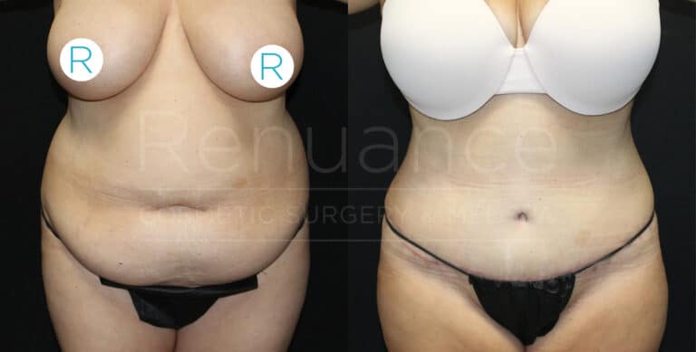 Before and after tummy tuck results demonstrating muscle repair