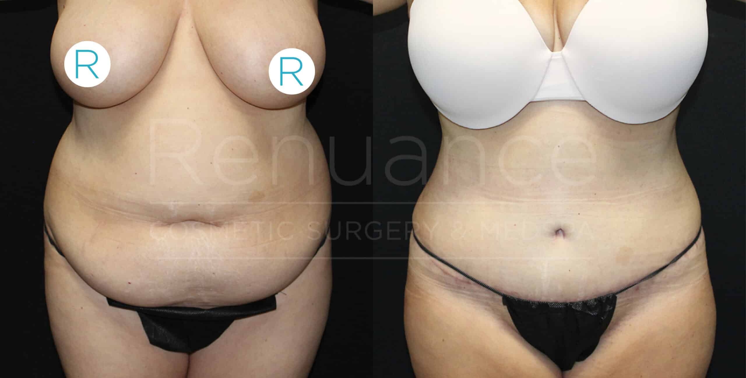 Before and after tummy tuck results demonstrating muscle repair