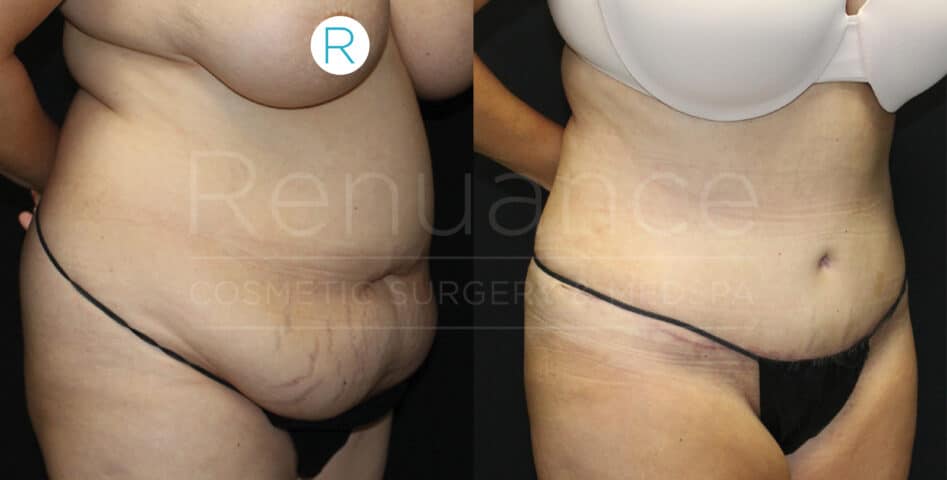 Post-surgical tummy tuck before and after from our Temecula practice