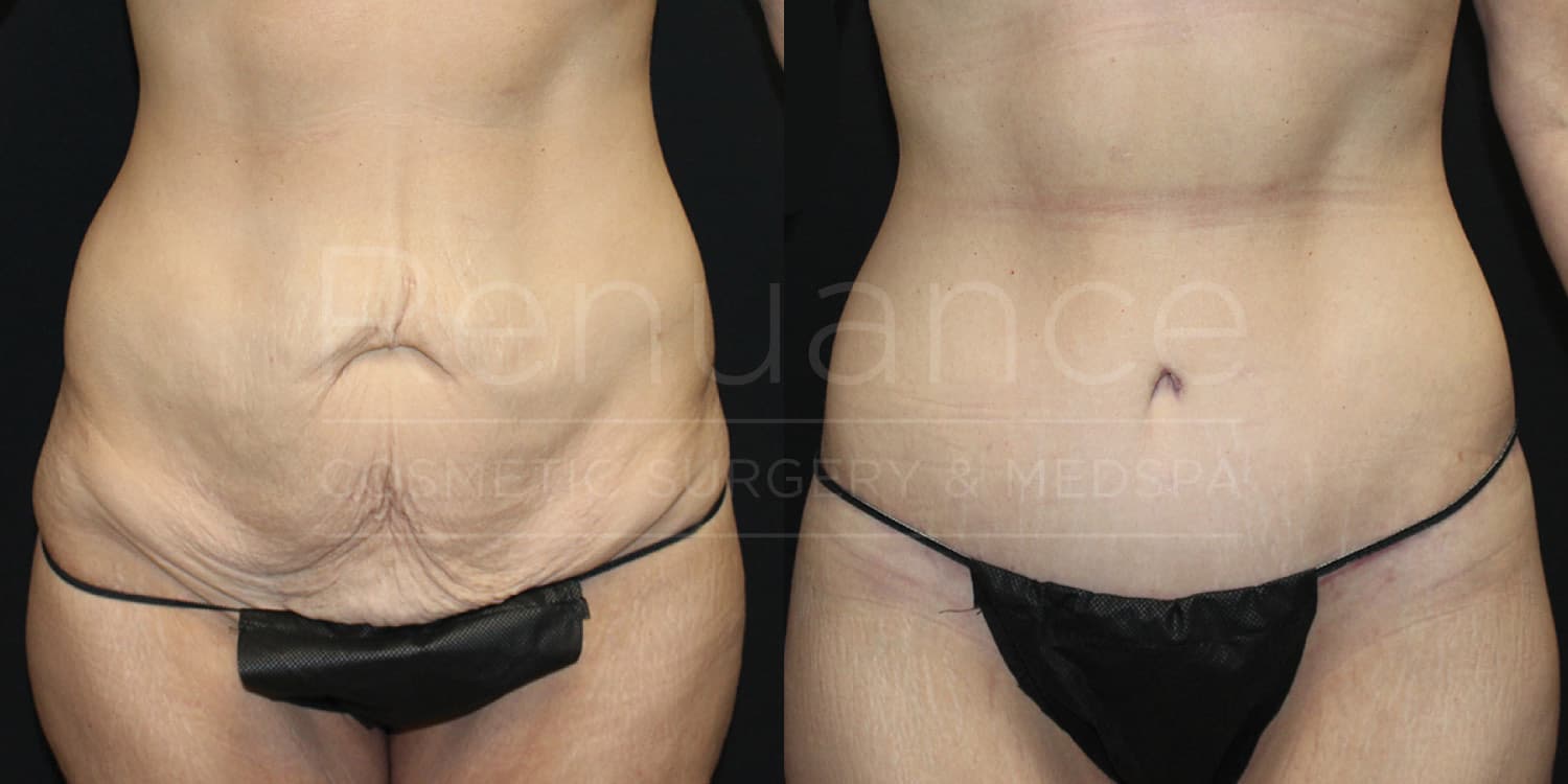 Before and after tummy tuck showing removal of excess skin