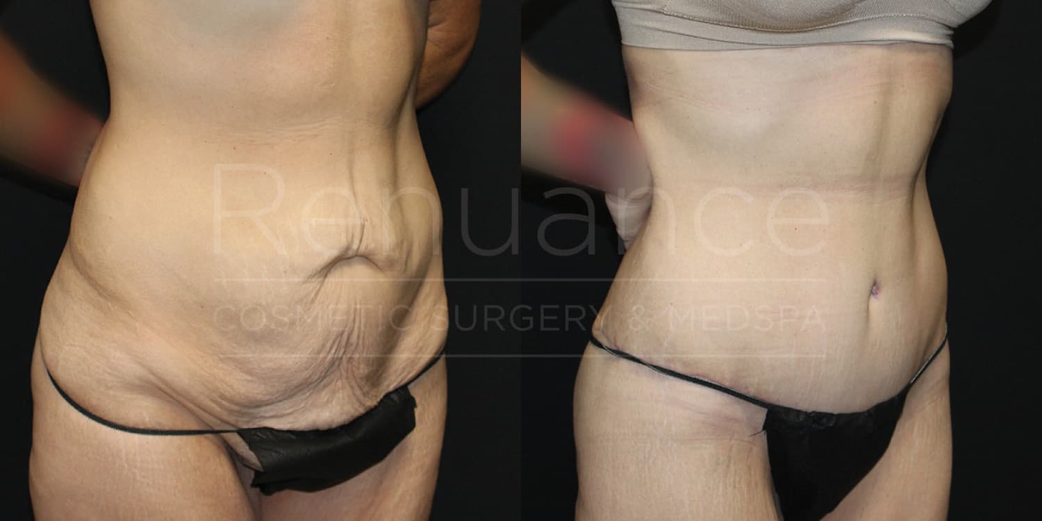 Tummy tuck before and after showing flattened abdominal profile