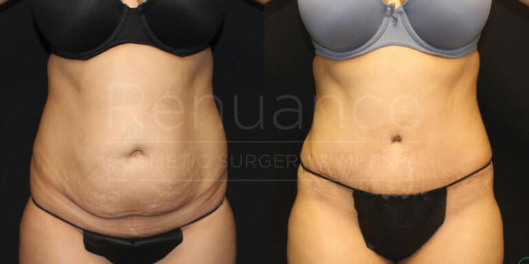 Before and after tummy tuck results showing improved waistline definition