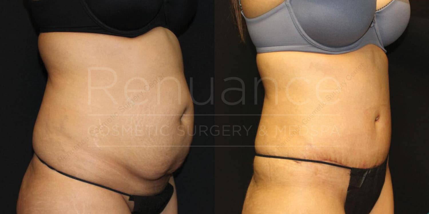 Before and after tummy tuck highlighting core restoration results