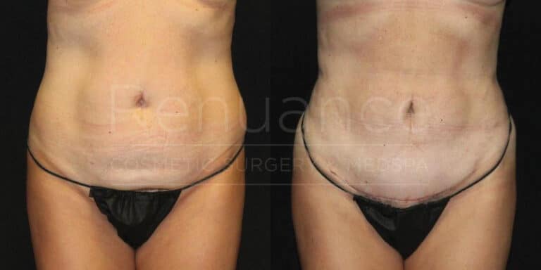 Post-pregnancy tummy tuck before and after results - Temecula clinic