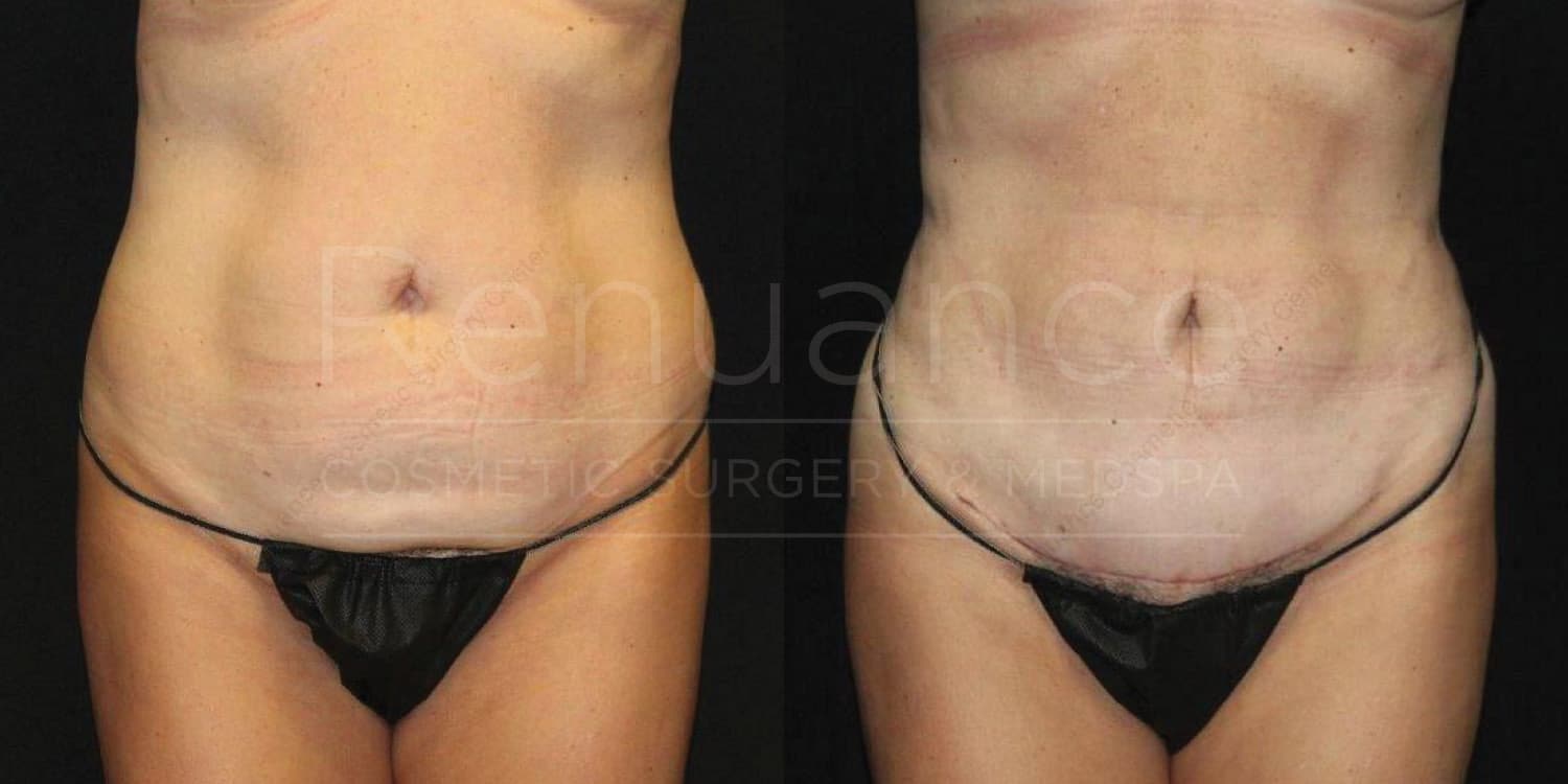 Post-pregnancy tummy tuck before and after results - Temecula clinic