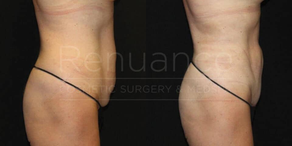 Before and after tummy tuck transformation - serving Murrieta area