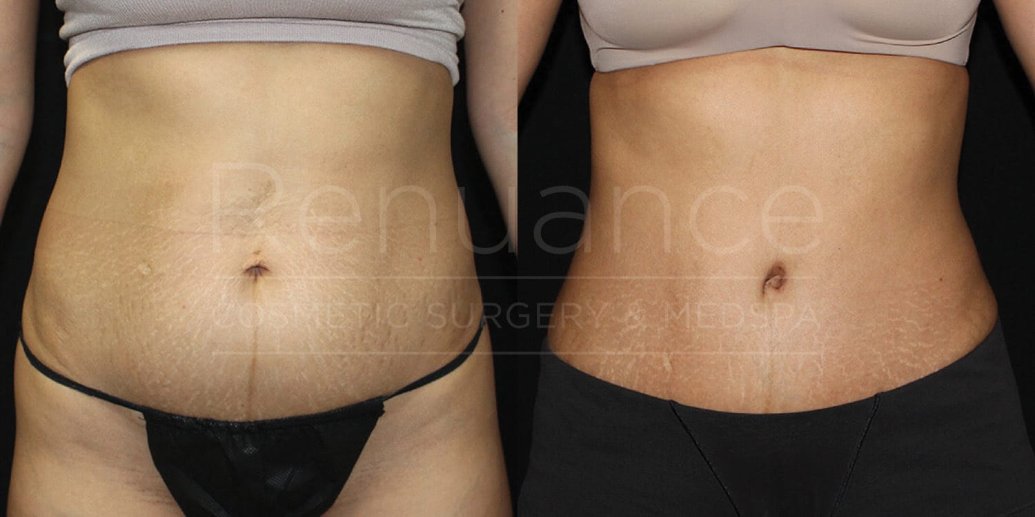 Tummy tuck before and after showing aesthetic improvement