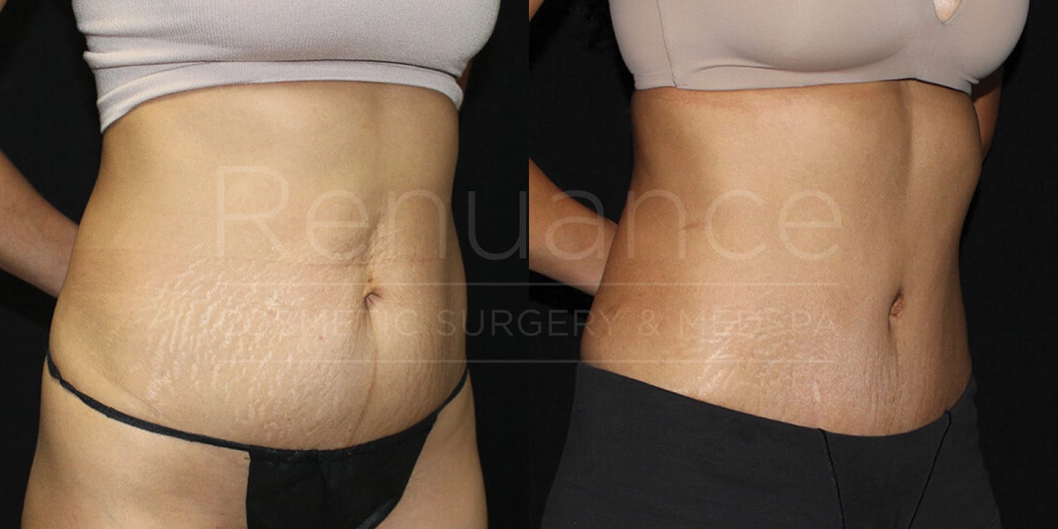 Before and after tummy tuck results from board-certified surgeon