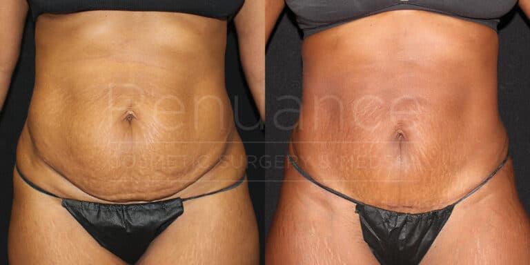 A side-by-side comparison of two images showing the abdomen area of an individual before and after a cosmetic procedure. The left image shows the abdomen with loose and sagging skin, while the right image shows the abdomen with tighter and smoother skin. Both photos show the individual wearing black underwear. The logo or watermark of "Renuance Cosmetic Surgery & Aesthetics" is visible in the background.