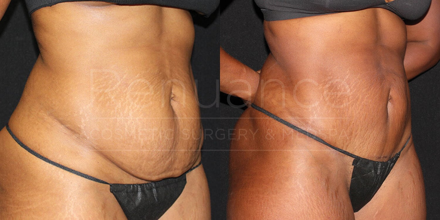 Two side-by-side images depict the abdomen of an individual before and after undergoing a cosmetic procedure. The left image shows a person with loose and sagging skin, characterized by visible stretch marks. The right image, taken post-procedure, shows a firmer and smoother abdominal area with significantly reduced sagging and stretch marks. The individual is wearing a dark bikini bottom in both images. Text in the background reads "Renuance COSMETIC SURGERY & MEDSPA."