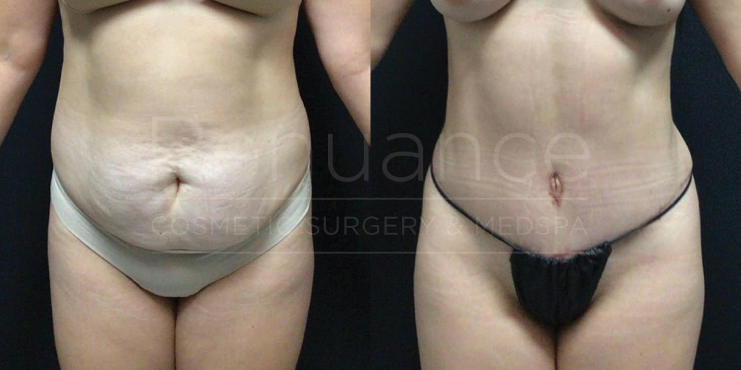 Before and after tummy tuck showing refined abdominal appearance