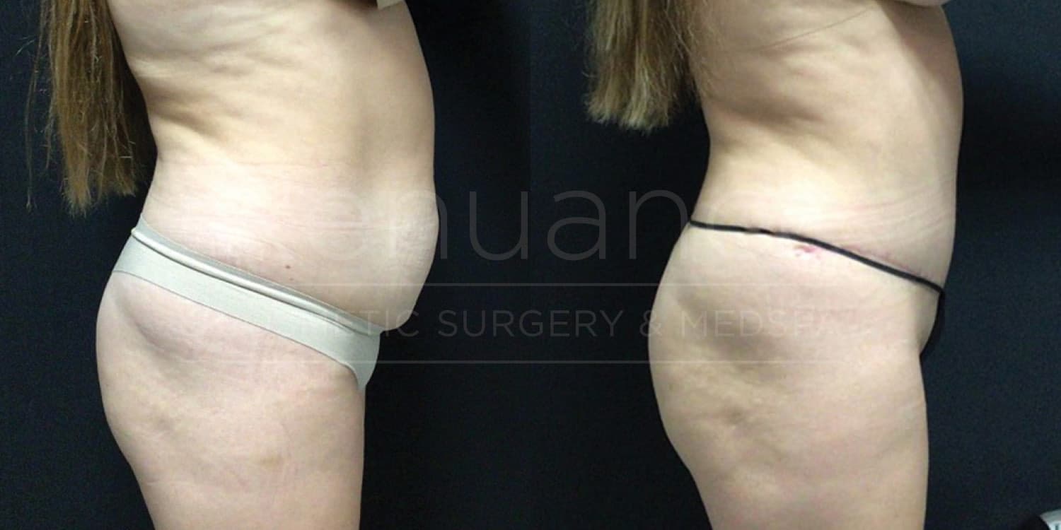 Before and after tummy tuck demonstrating abdomen recontouring