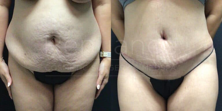 Before and after tummy tuck showcasing midsection improvement