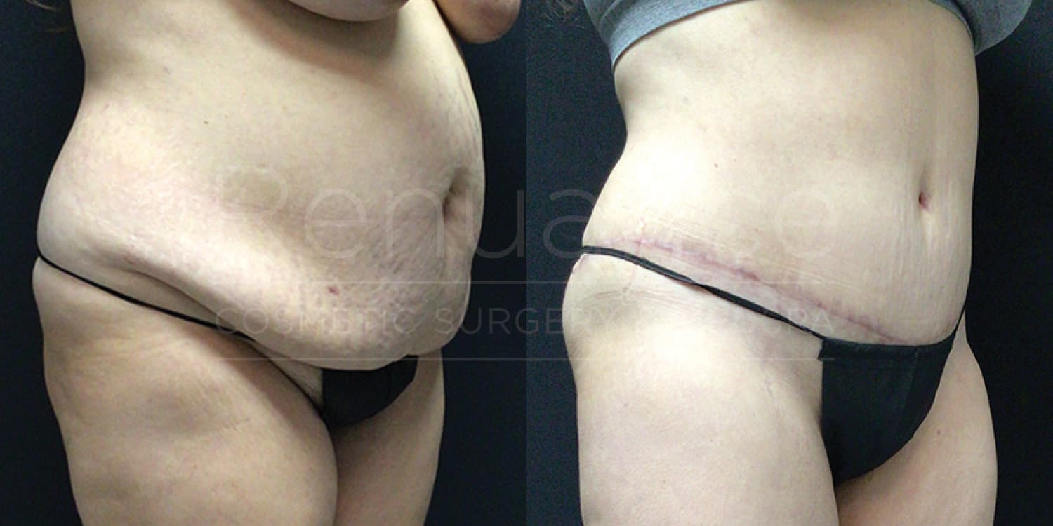 Tummy tuck results before and after - Murrieta surgical center