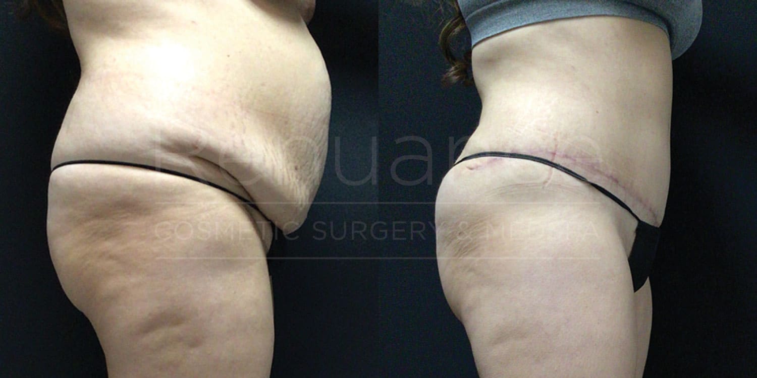 Before and after tummy tuck revealing transformed midsection