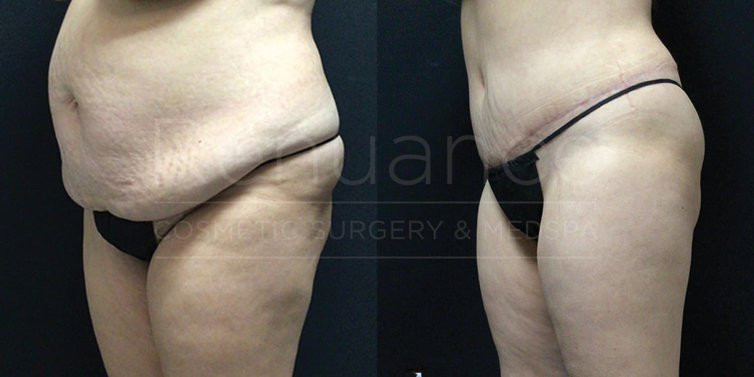 Professional tummy tuck before and after from our Temecula location
