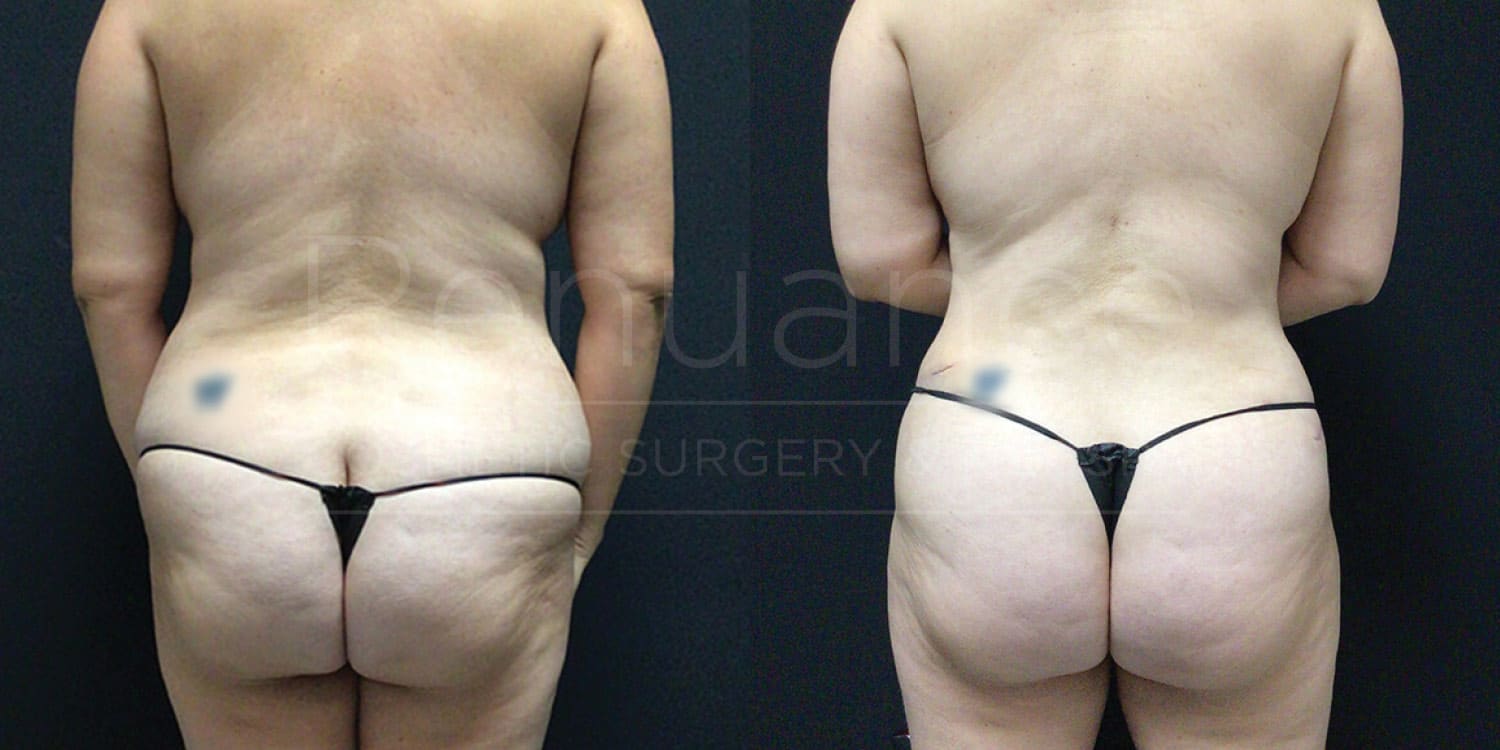 Tummy tuck before and after displaying surgical precision