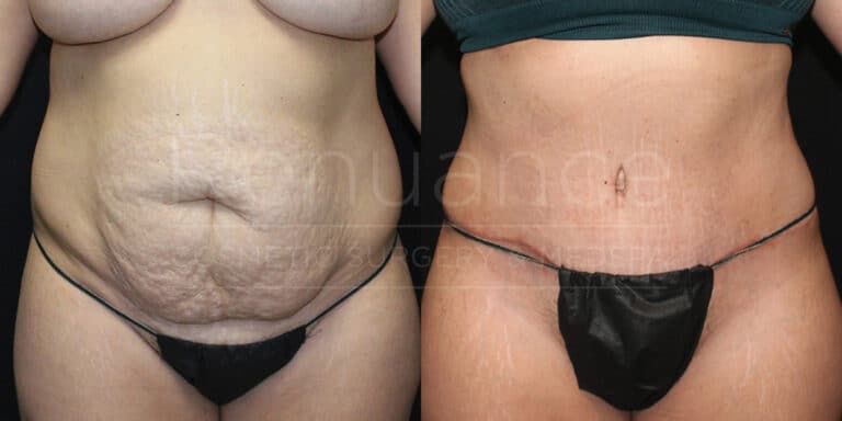 Before and after tummy tuck showing strengthened abdominal wall