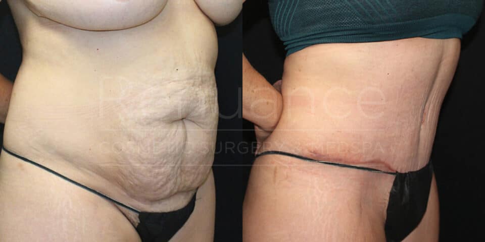 Before and after tummy tuck results revealing streamlined silhouette