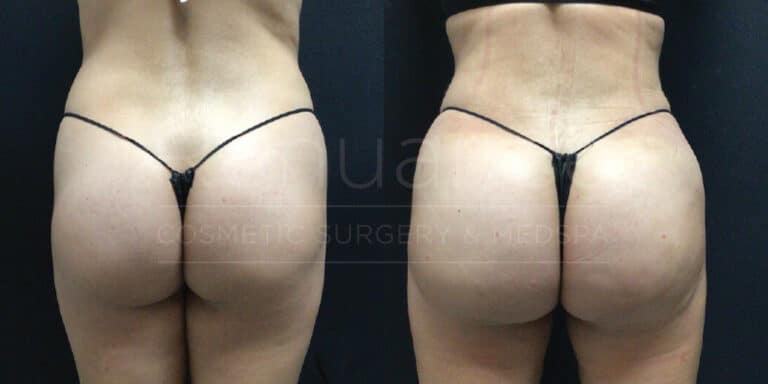 A side-by-side comparison image showing the back view of a person before and after cosmetic surgery. The person is wearing a black thong and the photos highlight changes to their buttocks and lower back area. The background is solid black.