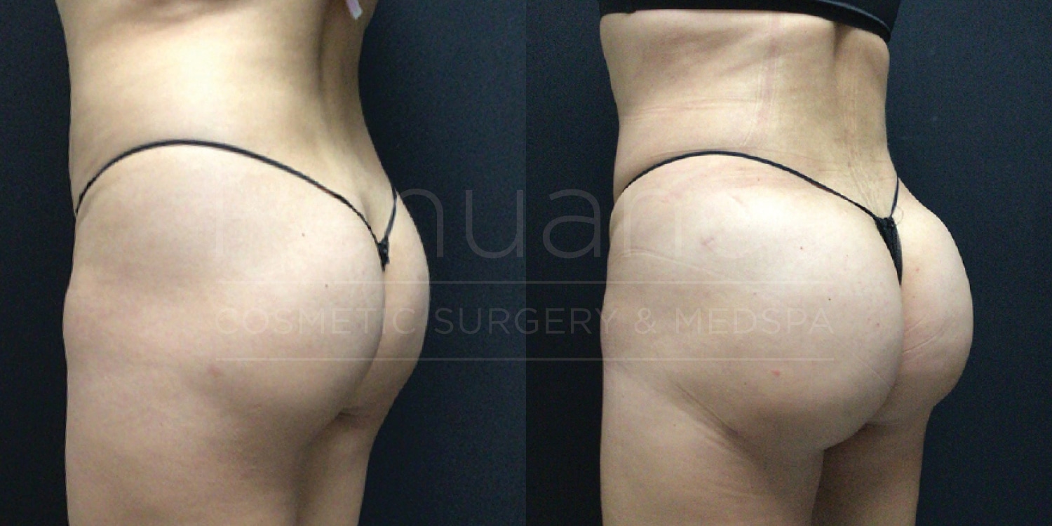 A side-by-side comparison image shows the results of a cosmetic surgery procedure. The left part of the image features a woman's lower back and buttocks before the surgery, while the right part of the image shows the same area after the procedure. The woman is wearing a black thong in both images. The after image demonstrates a more contoured and smoother appearance of the lower back and buttocks. The background is black, and the text "Lunaire Cosmetic Surgery & Medspa" is faintly visible