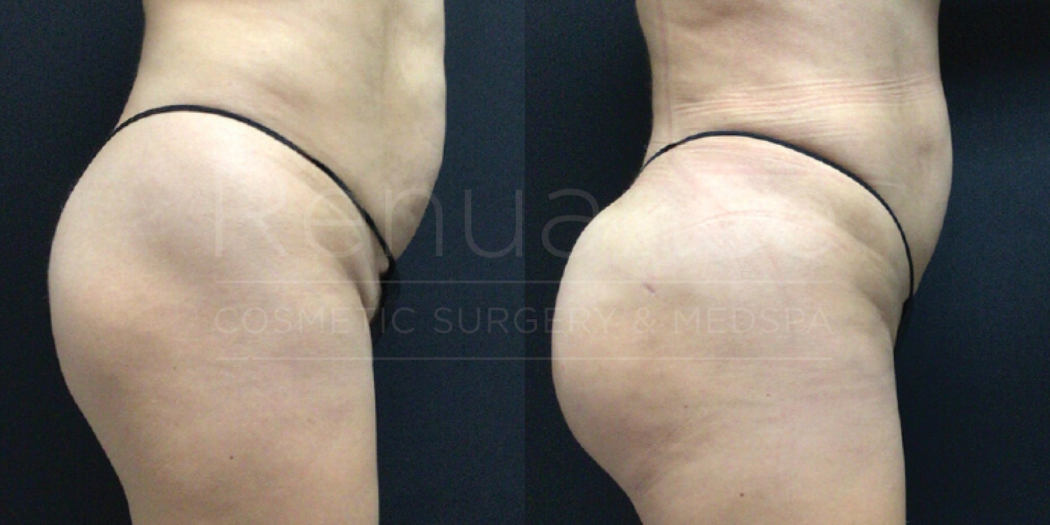 Side-by-side images showing the back view of a person's lower body before and after a cosmetic procedure. The left image shows the body before the procedure, and the right image shows the body after the procedure. The person appears to be wearing minimal clothing. The background is plain and dark.
