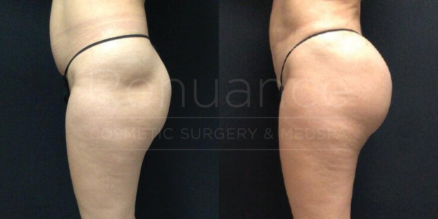 "Side-by-side comparison of a person's lower body before and after a cosmetic procedure. The left image shows the body prior to the procedure, while the right image shows the body afterward, with noticeable enhancements and improvements."