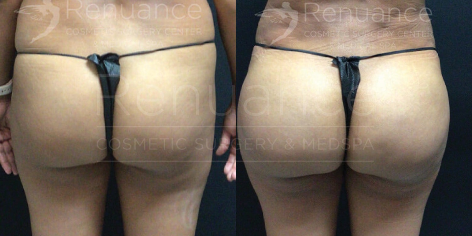 Side-by-side comparison of two images showing the back view of a person wearing a black thong. The image on the left shows the person before surgery, and the image on the right shows the person after a cosmetic surgery procedure, highlighting changes in the buttocks shape and contour. The text overlay reads "Renuance Cosmetic Surgery Center" and "Renuance Cosmetic Surgery & MedSpa."