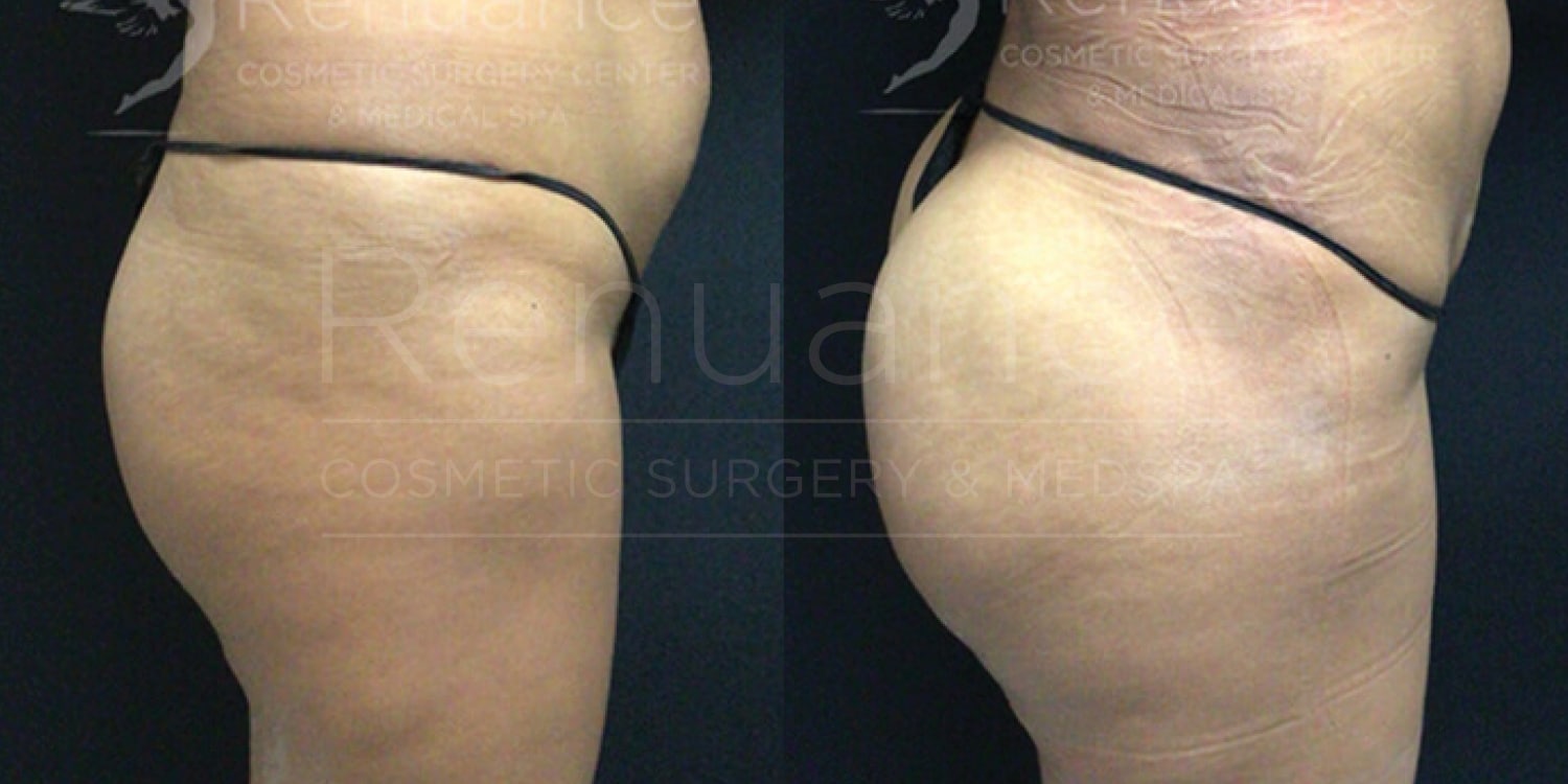 A side-by-side comparison of the same person's body before and after undergoing a cosmetic procedure. The left side shows the body before the treatment with visible loose skin and cellulite, while the right side shows the body after the treatment with noticeably smoother and tighter skin. The person is wearing minimal clothing in both images to clearly show the changes.